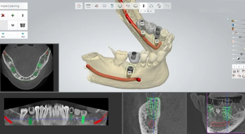 modelisation dentaire laboratoire dentotech bethune modelisation dentaire laboratoire dentotech bethune Nos solutions numériques Laboratoire dentaire DENTOTECH à Béthune